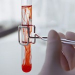 Кровь в сперме — стоит ли беспокоится?