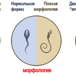 Недостаток спермы (гипоспермия) может стать причиной бесплодия