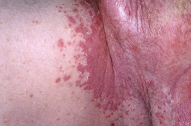 Грибковое заболевание кожи в паху